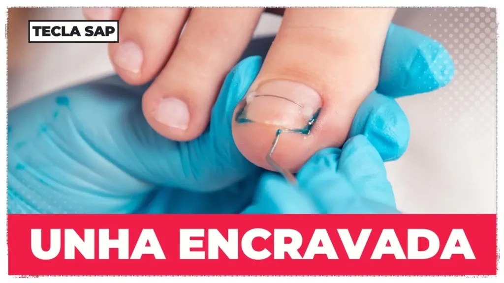 UNHA ENCRAVADA